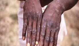 পাকিস্তানে ভয়ংকর এমপক্স ভাইরাসের সংক্রমণ শনাক্ত হয়েছে