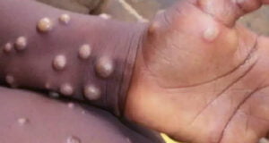 মাঙ্কিপক্স আফ্রিকা এবং তারপর সুইডেনে ছড়িয়ে পড়ে।